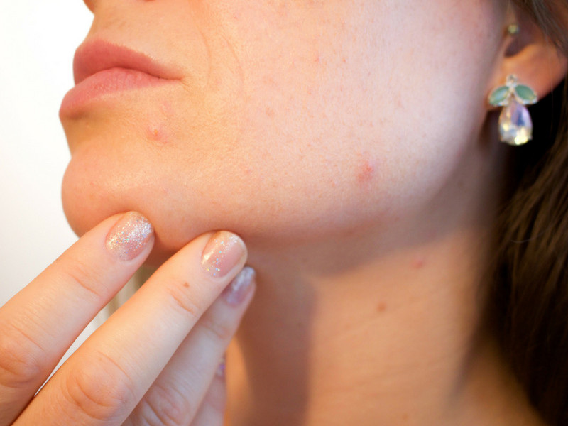 Triệu chứng và cách trị nổi mụn do nóng trong người