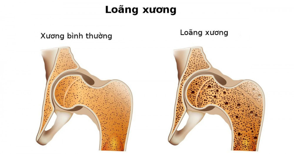 Canxi Nano Plus - hỗ trợ phòng ngừa bệnh loãng xương