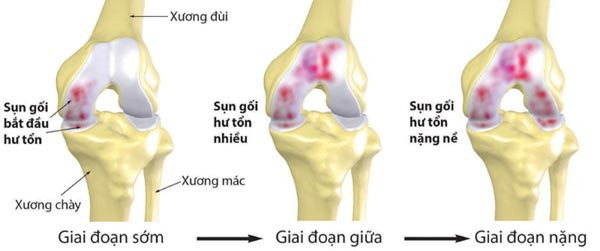 Biến chứng thoái hóa khớp gối có nguy hiểm không?
