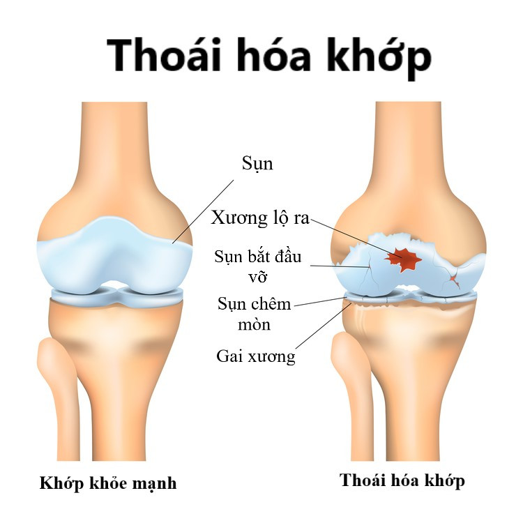 Biến chứng thoái hóa khớp gối có nguy hiểm không?
