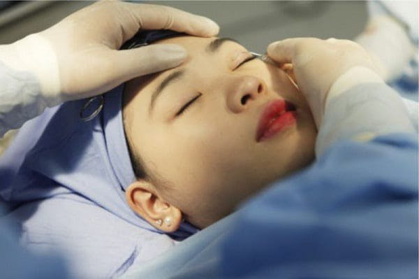 Lý do nhấn mí mắt là gì? Phương  thức làm đẹp được nhiều người ưa chuộng