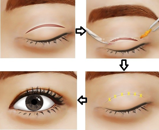 Phân tích ưu nhược điểm của nhấn mí mắt và cắt mí mắt