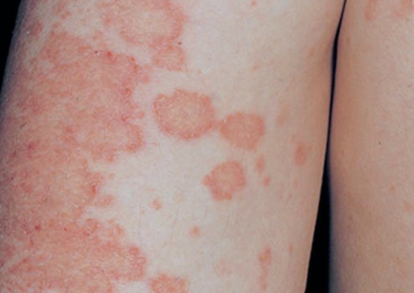 Bệnh chàm - Eczema: nguyên do, triệu chứng và cách đánh bay bệnh chàm