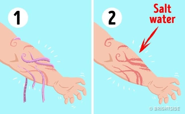 Cách xử lý nếu chẳng may bị sứa chích
