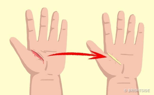 Dùng keo dán vết thương hở