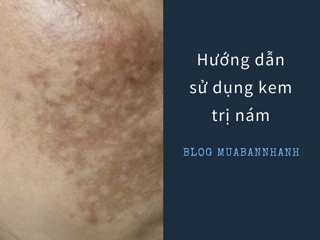 Hướng dẫn cách dùng kem trị nám tàn nhang an toàn nhất cho da