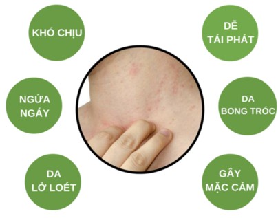 Viêm da cơ địa là gì?