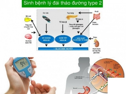 Bệnh tiểu đường tuýp 2